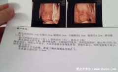B超单3个数据看男女，孕囊形状长条是男宝