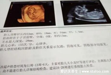NT三个亮点是男孩女孩,3个亮点男孩/3条线女孩(双腿间)