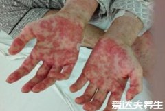 白血病初期小血点图片及症状，为皮肤瘀斑