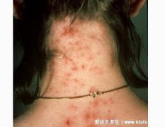 虫咬性皮炎图片及症状,图解各种虫咬症状