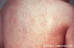 各种皮疹图片和症状图片介绍,包括风疹/手