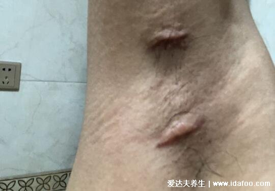 千万不要做狐臭手术后悔死了,可能有4大后遗症(复发/留疤)