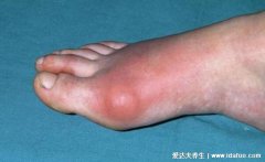 尿酸高有哪些症状不能吃什么食物，关节肿