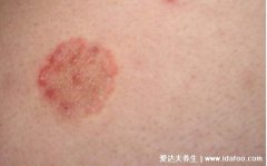 千年治癣的老秘方配方，7大特效偏方巧治多