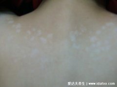 轻度刚长出来的白斑图片，早期汗斑花斑癣
