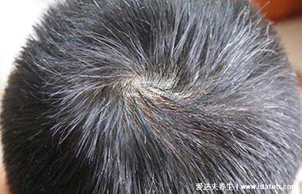 三个部位长白发最危险,前额脾胃失调/头顶肾气不足