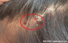 头皮上有大块头皮屑还有结痂怎么回事,警