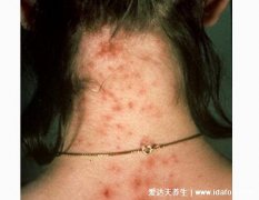 图解各种虫咬症状,虱子/跳蚤/蜱虫等7种虫