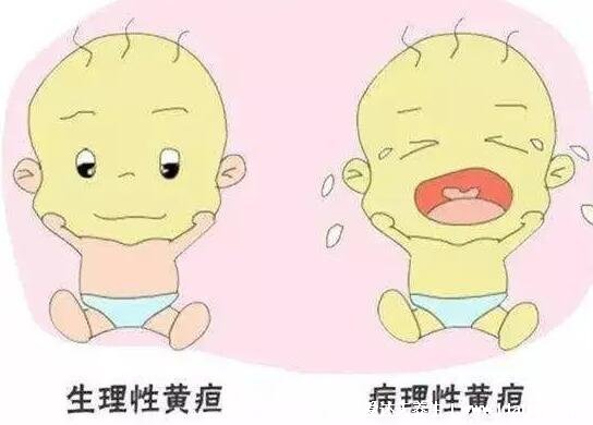 新生儿黄疸一般多久完全退干净,生理性2周/4周(病理性不好说)