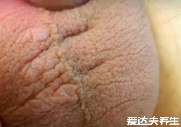3种类型的阴囊湿疹图片,阴囊发红肿胀伴随瘙痒要小心