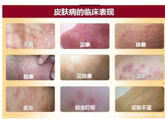 5种普通皮癣图片早期症状,手藓足藓成人多见(甲藓就是灰指甲)