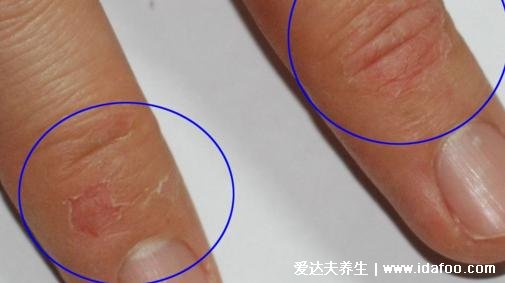 5种普通皮癣图片早期症状,手藓足藓成人多见(甲藓就是灰指甲)