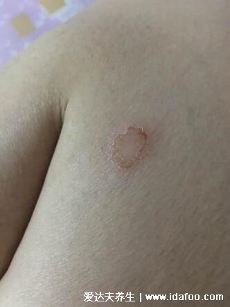 5种普通皮癣图片早期症状,手藓足藓成人多见(甲藓就是灰指甲)