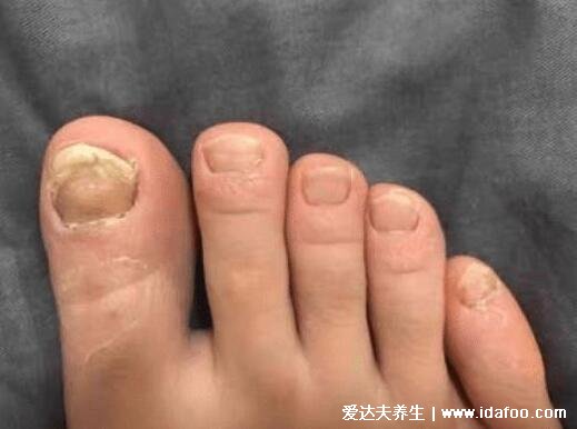 5种普通皮癣图片早期症状,手藓足藓成人多见(甲藓就是灰指甲)