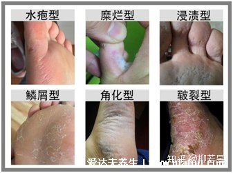 5种普通皮癣图片早期症状,手藓足藓成人多见(甲藓就是灰指甲)