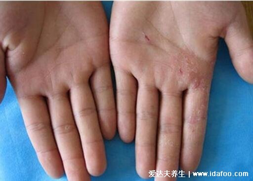 5种普通皮癣图片早期症状,手藓足藓成人多见(甲藓就是灰指甲)