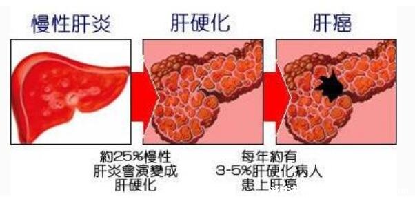 7大肝硬化早期症状,警惕蜘蛛痣和肝掌的出现