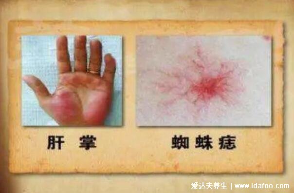 7大肝硬化早期症状,警惕蜘蛛痣和肝掌的出现