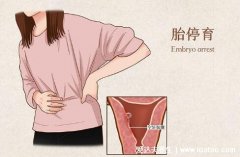 12周胎停后又活胎了，可能是医生判断失误