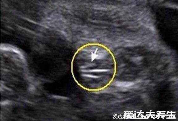 b超四维单子上3个亮点是男孩,3个红色的小点可能男孩(线是女孩)