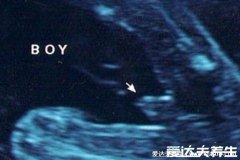 B超有两点基本是男孩，三条线是女孩(图片