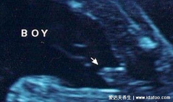 NT三个亮点是男孩女孩图片,是男孩的生殖特点(三条线为女孩)