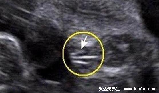 NT三个亮点是男孩女孩图片,是男孩的生殖特点(三条线为女孩)