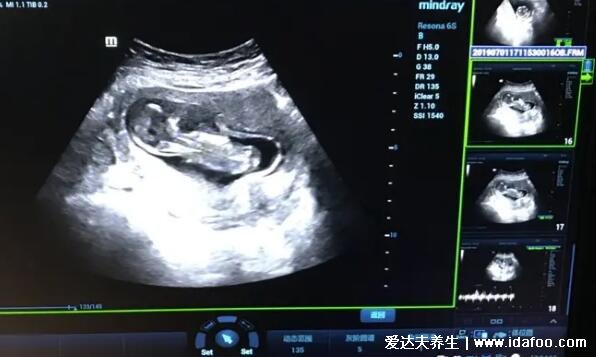 NT三个亮点是男孩女孩图片,是男孩的生殖特点(三条线为女孩)