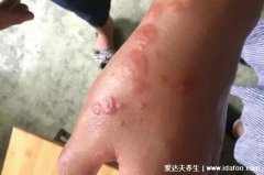 艾滋病一开始的皮肤图，初期手上水泡图