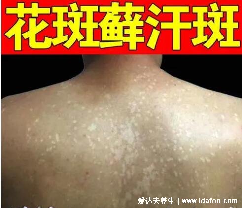 白斑癣的早期症状图片,有鳞屑且可能会痒(经常出汗要注意)