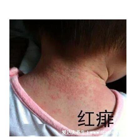 宝宝小儿痱子症状图片,3种类型痱子中热痱最常见(痱子是一粒粒)