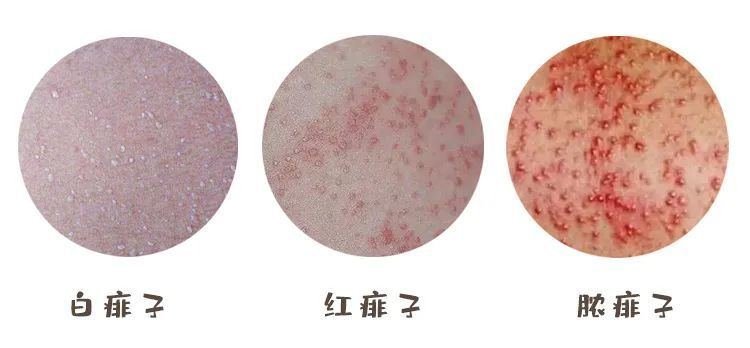 宝宝小儿痱子症状图片,3种类型痱子中热痱最常见(痱子是一粒粒)