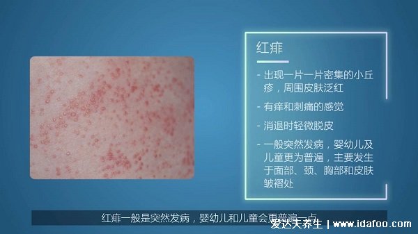 宝宝小儿痱子症状图片,3种类型痱子中热痱最常见(痱子是一粒粒)