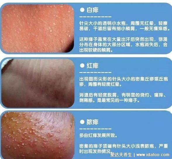 宝宝小儿痱子症状图片,3种类型痱子中热痱最常见(痱子是一粒粒)