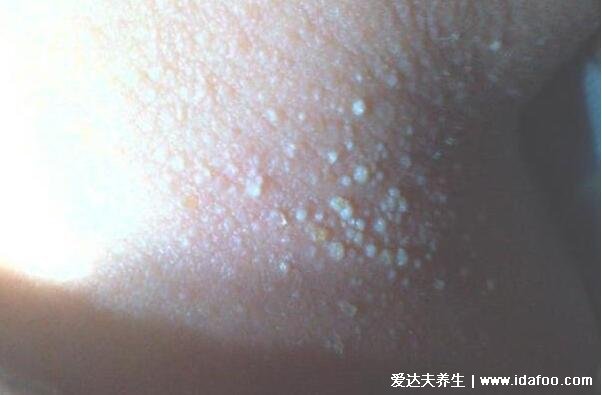 宝宝小儿痱子症状图片,3种类型痱子中热痱最常见(痱子是一粒粒)