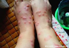 被跳蚤咬的症状图片,直线形或三角形排列