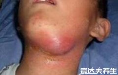 脖子淋巴癌早期图片，颈部有明显肿块且无