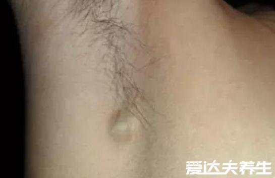 脖子淋巴癌早期图片，颈部有明显肿块且无痛感可能是患上了癌症