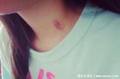 草莓印快速消失的办法，4个小妙招三分钟快