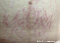 产后真实妊娠纹图片，有腿部腹部早期图片