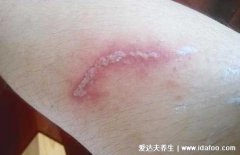 初期隐翅虫皮炎图片及症状,皮肤红肿长水