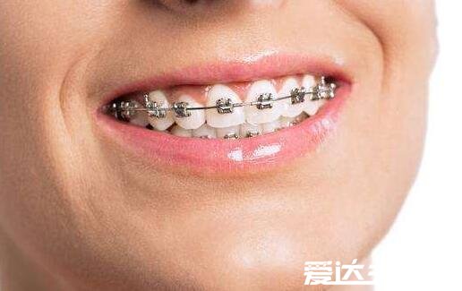 带牙套的年龄,12到18岁最适合带牙套(三大注意事项)