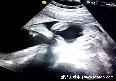 二胎怀女孩最明显特征,5个100%生女儿的症状(形状说明一切)