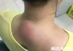 富贵包怎么形成的有什么危害，日常姿势不