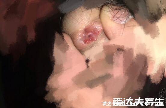 肛门处长了一个肉疙瘩是怎么回事，不一定是痔疮还有三大原因