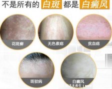 胳膊上长白斑图片，要警惕4种情况(白癜风可