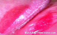 龟头炎症状对照图片，6种最常见的龟头炎早