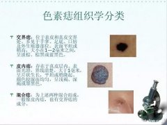 黑色素痣和普通痣的区别图片,黑色素痣形