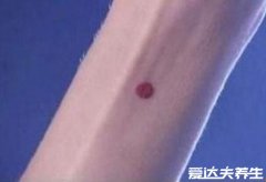 红痣与朱砂痣区别图片，两者没有区别(附朱
