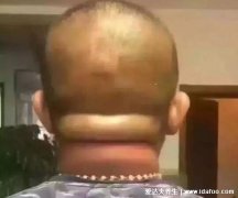 后脑勺疼痛要警惕四种疾病,偶尔两侧疼痛